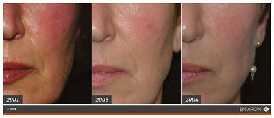 A close-up of a woman’s face showing progressive skin improvement from 2001 to 2006, with the final image featuring a pearl earring and an environ logo.
