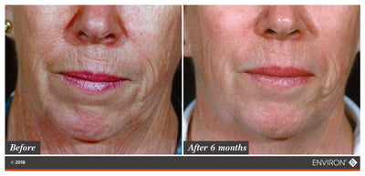 The image shows a before-and-after comparison of facial skin, with the ’after 6 months’ side displaying smoother and more youthful-looking skin.