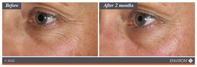 The image shows a before-and-after comparison of an eye area, with the ’after 2 months’ side displaying smoother skin and reduced wrinkles.